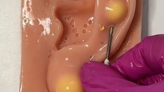 دعنا نضيف حبّة بثور أولاً