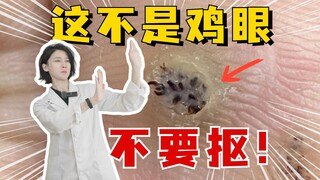 这可不是鸡眼，千万别乱处理！