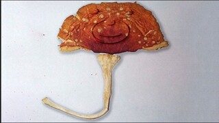 هذا ما حدث لدماغ رجل بعد تناول كمية كبيرة من الفطر السام الذي اشتراه عبر الإنترنت.