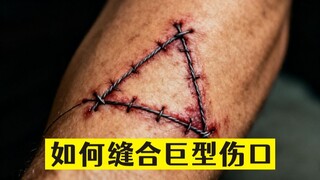 แยบยลจริงๆ แพทย์缝ไหม้บาดแผลขนาดใหญ่ได้อย่างไร