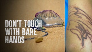 How to Survive a Portuguese Man O' War