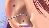 MASSIVE EAR ACNE REMOVAL AND TREATMENT
