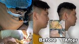 GOODBYE DOUBLE CHIN! (SUBMENTAL LIPO AND BUCCAL FAT REMOVAL FULL SURGERY) - Gagitavision No. 51