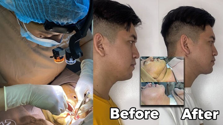 GOODBYE DOUBLE CHIN! (SUBMENTAL LIPO AND BUCCAL FAT REMOVAL FULL SURGERY) - Gagitavision No. 51