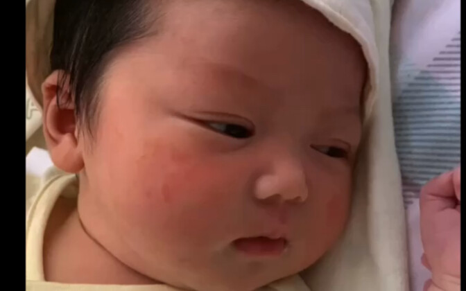 ประวัติวิวัฒนาการของเปลือกตาสองชั้นในเด็กเล็ก