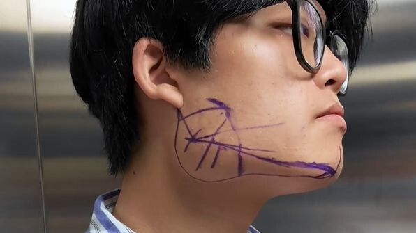 [Qiu Lidong] 189-Cm Man Undergoes Jawline Contouring: The Mockery Around Him Has Become His Motivati