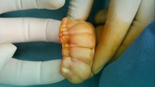 Baby's hands have grown into "little spoons," and the five fingers can be reshaped without skin graf