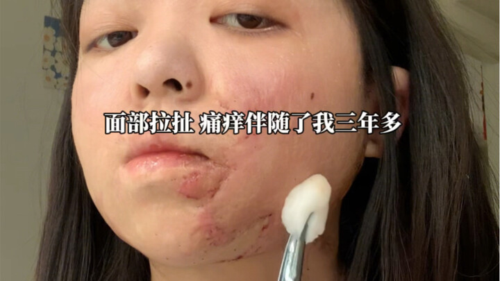 Tám ngày sau phẫu thuật cuối cùng cũng được cắt chỉ!