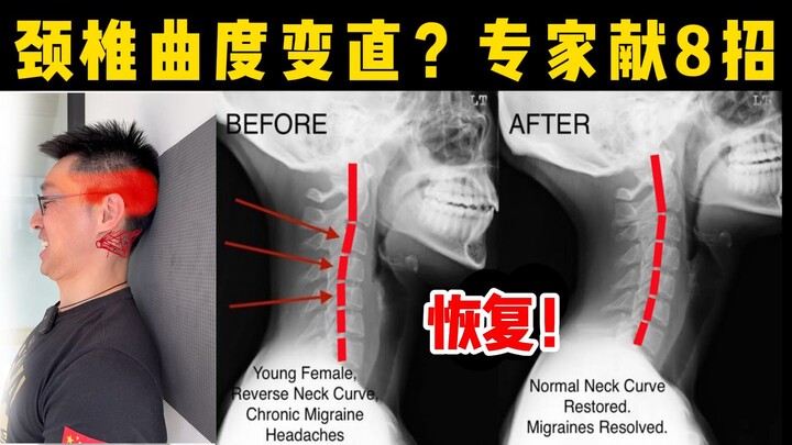 【Tiến sĩ, bác sĩ trị liệu cột sống Olympic Lý Bằng】 Cột sống cổ bị thẳng, 8 động tác phục hồi kinh đ