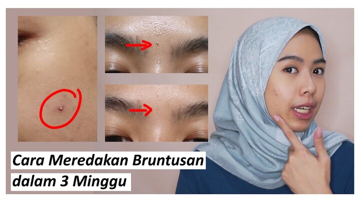 Bruntusan & Jerawat Hilang Pakai Serum Eksfoliasi Lokal | Review Lacoco Dark Spot Essence