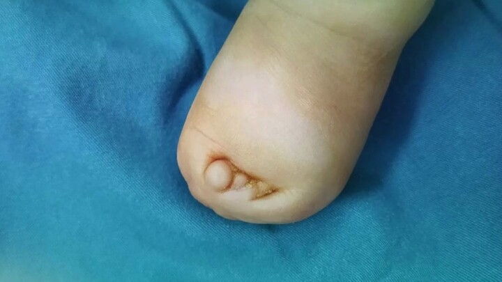 น่าสงสารจัง เท้าของเสี่ยวเป่าถูกพันจนเบียดเป็นก้อน ต้องใช้ครั้งเดียวแยกออกถึง 5 นิ้วเท้าเลย