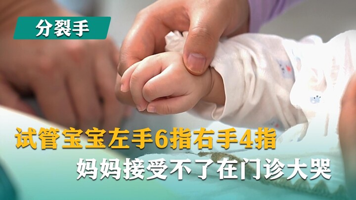 Em bé thụ tinh trong ống nghiệm có 6 ngón tay ở bàn tay trái và 4 ngón ở bàn tay phải; mẹ không chấp