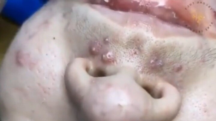 Blackhead nose Removal