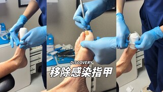 ⚠️TW⚠️移除被真菌感染的大拇指😨