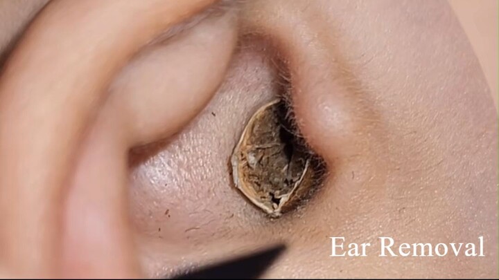 Ear cleaning #foryou #earwax #pimple #relax #earwaxremoval