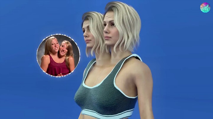 Apa? Pasangan kembar siam yang sangat langka di seluruh dunia!