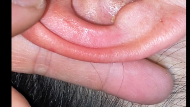 How many years without ear cleaning—look at this huge wax build-up!