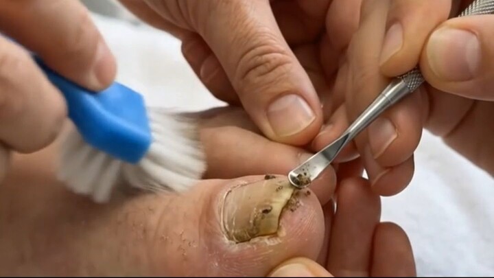 Dirty & Overgrown Toenails Get a Deep Clean and Perfect