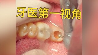 POV: Kamu adalah dokter gigi yang sedang melakukan perbaikan gigi berlubang