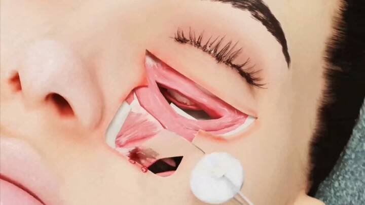 Surgeon removes a tumor from the eye socket
