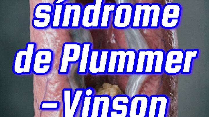 💊        𝙈𝙚𝙢𝙗𝙧𝙖𝙣𝙖 𝙚𝙨𝙤𝙛𝙖́𝙜𝙞𝙘𝙖 𝙮 𝙨𝙞́𝙣𝙙𝙧𝙤𝙢𝙚 𝙙𝙚 𝙋𝙡𝙪𝙢𝙢𝙚𝙧-𝙑𝙞𝙣𝙨𝙤𝙣