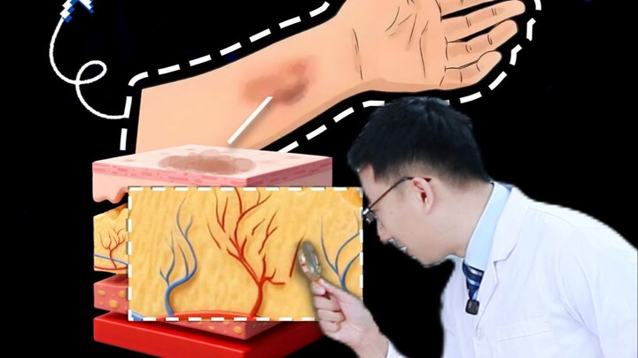 Mengapa tubuh selalu muncul memar tanpa sebab? Apakah ini tanda awal penyakit?