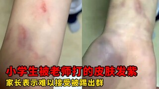 นักเรียนชั้นประถมศึกษาในเมืองเจียหยางถูกครูทำร้ายร่างกายจนผิวหนังกลายเป็นสีม่วง และผู้ปกครองของเด็กก