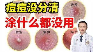 [Pengetahuan Umum] Kamu bisa membedakan berbagai jenis jerawat, pantas saja wajahmu mulus!