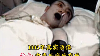 The real image of Tsinghua University talent Zhu Ling after thallium poisoning, paralyzed in bed, tu