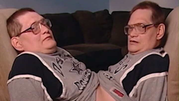 Siamese twins who lived to 69 share the same body but have completely different personalities.