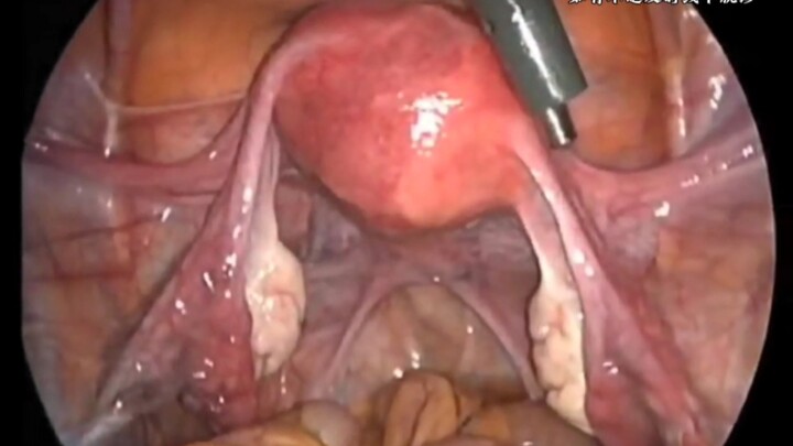 Using laparoscopy to help you get to know the organs in the female pelvic cavity.