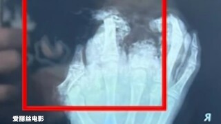 A boy set off firecrackers during Chinese New Year and had three of his fingers blown off. His famil