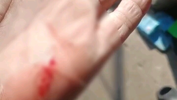 A man accidentally injured himself while working, sustaining a 3–4 cm-long laceration on his hand. H