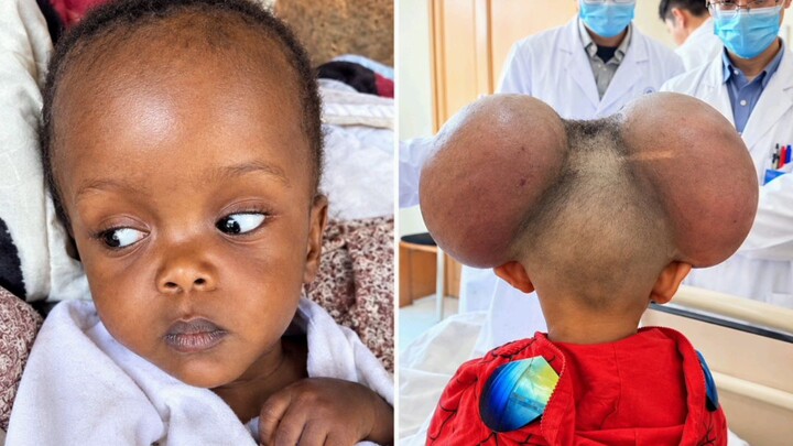 Large Tumor-Like Swelling on a Child's Head: Causes, Symptoms & Recurrence Risk After Surgery