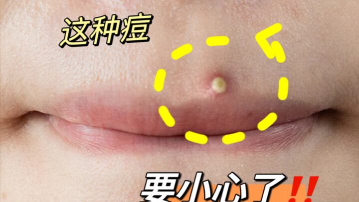 Kalau muncul jerawat seperti ini di wajah… harus benar-benar waspada!