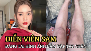 Sam khiến netizen "hết hồn" vì cả người bầm dập, tay chân đầy vết trầy, chuyện gì đây?