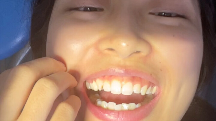 “Buku Harian Cabut Gigi Bungsu” Aku Benar-Benar Berani Banget!!