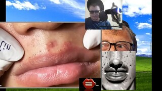 comedones, pimples.Выдавливание коомедонов с губ