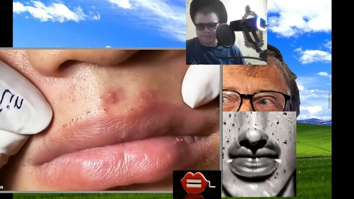 comedones, pimples.Выдавливание коомедонов с губ