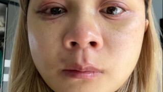Before vs. After Bone Contouring