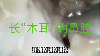 هل سبق لكم أن رأيتم تجويفًا أنفيًا ينمو عليه "فطر الأذن"؟