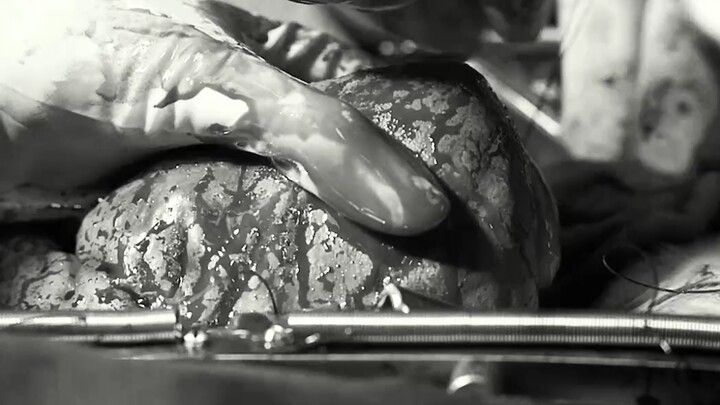The director was still busy suturing the heart, but the intern holding the heart fell asleep