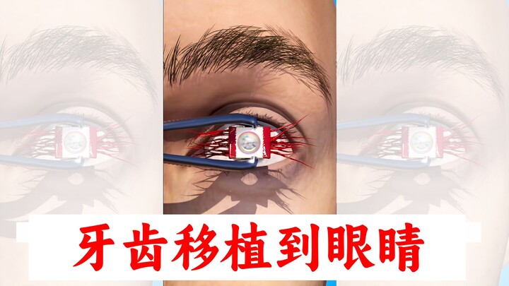 Transplanting Teeth to the Eyes to Restore Vision [Medical Science Popularization]