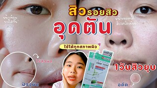 สิวผด สิวอุดตันไม่มีหัว สิวหายใน1วัน รีวิวClearnose ลดสิวรอยสิวเร่งด่วน❗️หน้าใสเนียนขึ้นมาก|ikziice