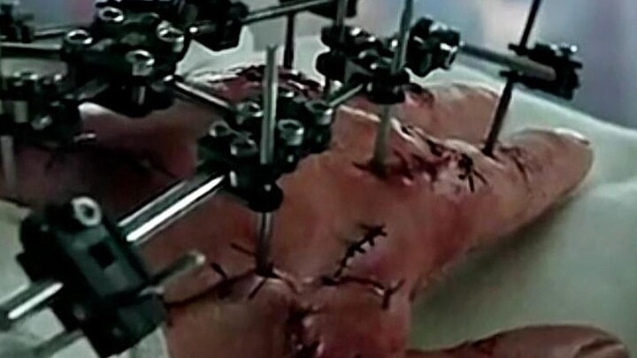 มือของชายคนหนึ่งที่ถูกปักด้วยตะปูเหล็กจนเต็ม รักษาหายได้ด้วยเงินเพียง 25 หยวน แถมยังกลายเป็น "จอมเวท
