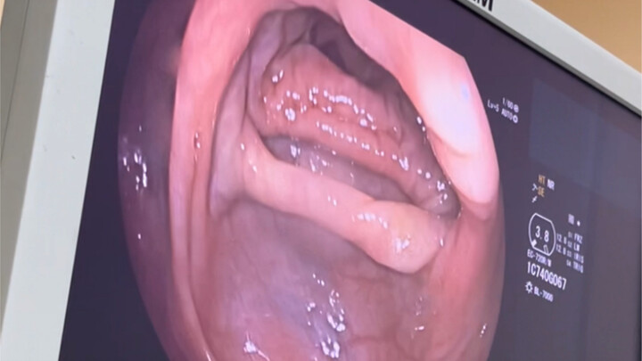 Không gây mê mà nội soi đại tràng, vừa quay video vừa trò chuyện với bác sĩ; biết thế đã mang theo m