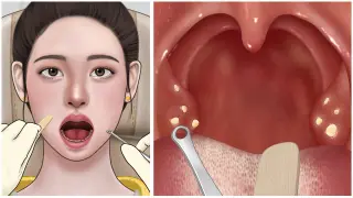 [ASMR] 입냄새의 원인! 편도결석 제거 애니메이션 / Cause of bad breath! Tonsil stone removal animation