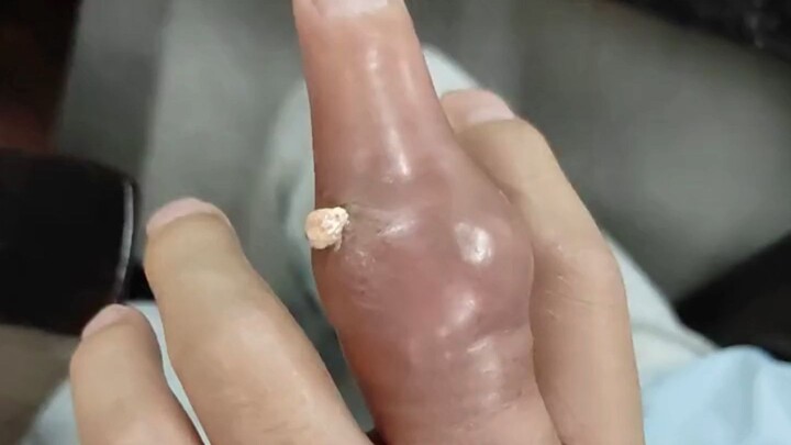 Gouty tophi on the middle finger—have you ever seen one this big?