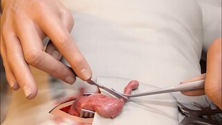 I performed an appendectomy on myself.