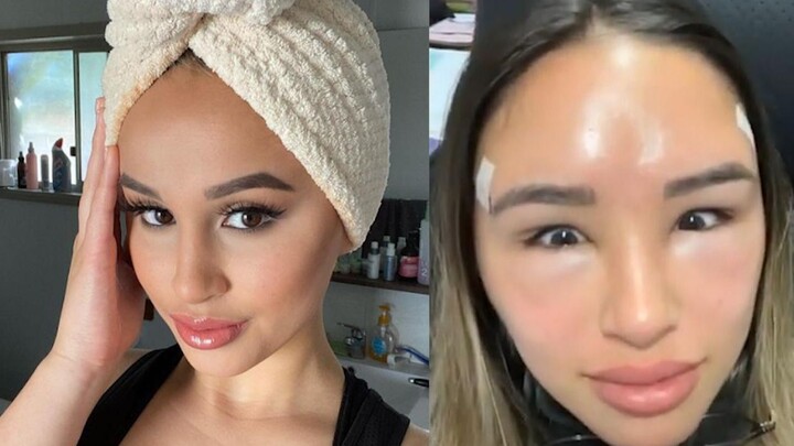 สาวต่างประเทศยอมผ่าตัดทำตาสองชั้นให้เป็นตาเด่นฟงเพื่อตามเทรนด์ความงาม แต่ผลลัพธ์กลับกลายเป็นเรื่องขำ